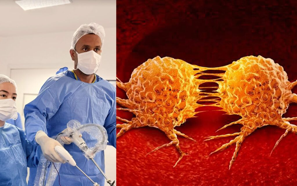 Metástase no fígado: quando o câncer pode ser tratado com cirurgia? 