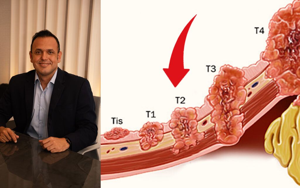 Câncer de pâncreas: quando o tumor pode ser operado?